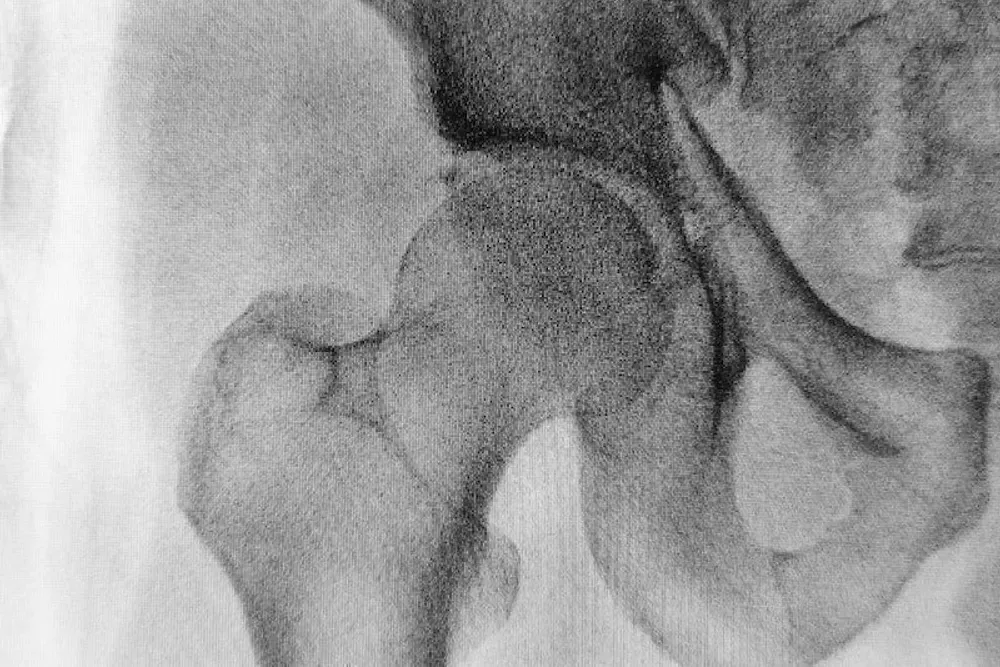 Can Chiropractors Provide Relief from Osteoarthritis? — Body Therapy Chiropractic, Chatswood